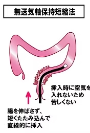 無送気軸保持短縮法って？