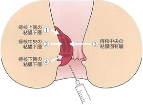 どのようにジオン注を、投与するのでしょうか？